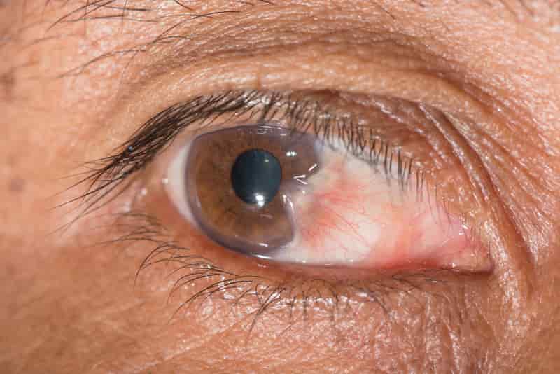ปิดการนำเสนอด้วยโรคเกี่ยวกับดวงตา: ต้อเนื้อ